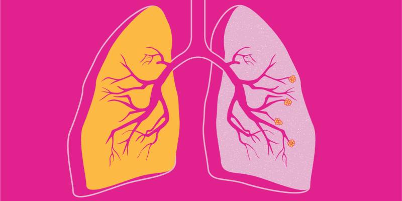 Quiz: What is COPD Or Chronic Obstructive Pulmonary Disease?