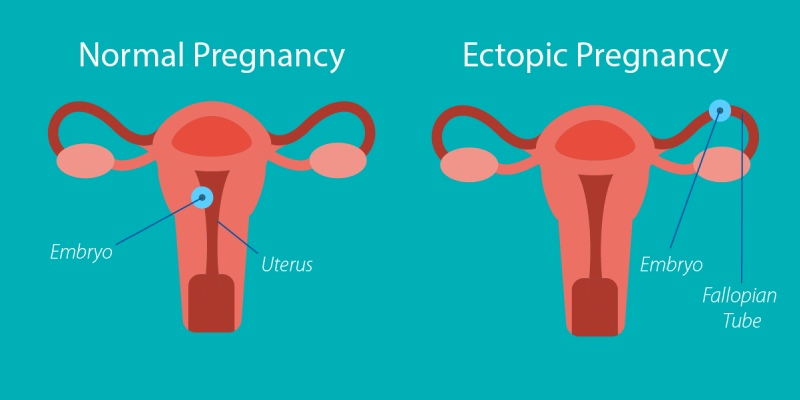 Ectopic Pregnancy Trivia Quiz